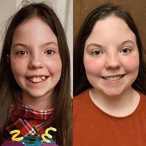 Antes y después de la sonrisa de una niña morena con el tratamiento Invisalign®