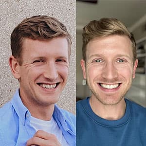 Antes y después de la sonrisa de un joven rubio con el tratamiento Invisalign®