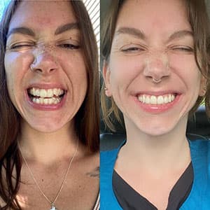Antes y después de la sonrisa de una chica con pecas con el tratamiento Invisalign®