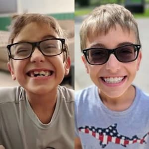 Antes y después de la sonrisa de un niño rubio con gafas con el tratamiento Invisalign®